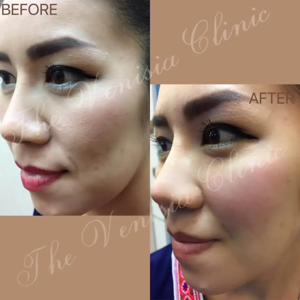 Before After หลุมสิวชัด ผิวเรียบขึ้นด้วย Air Dissector
