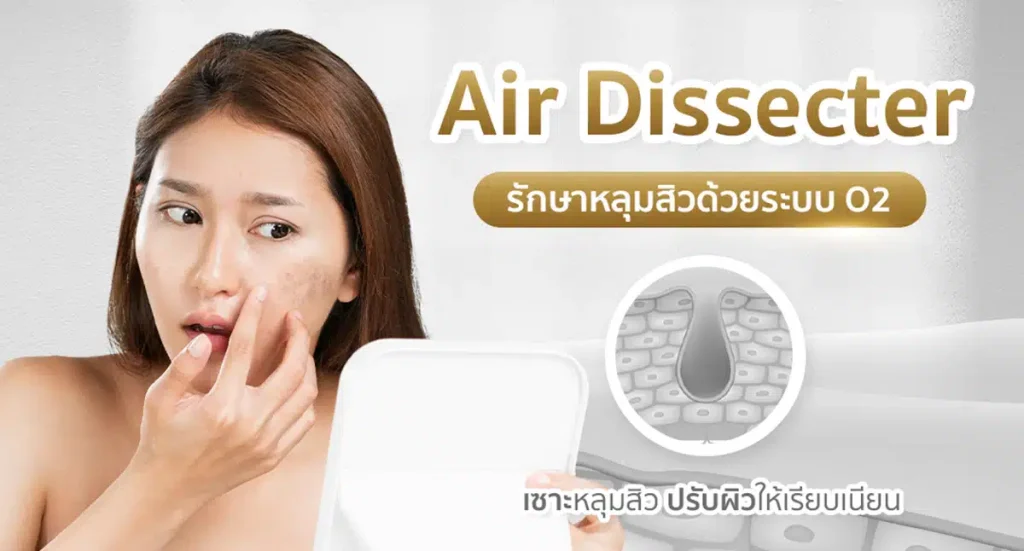 ผู้หญิง รักษาหลุมสิว ด้วย Air Dissector เทคโนโลยี O2