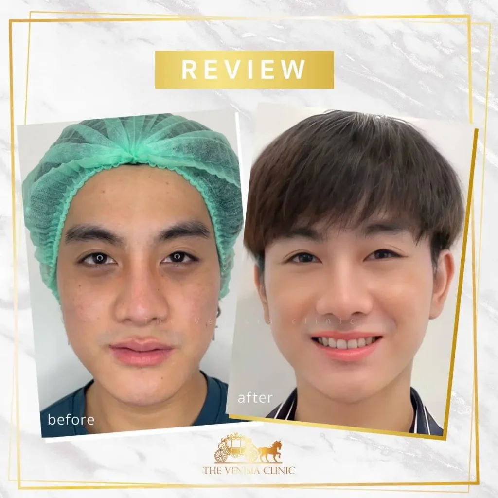 รีวิวรักษาหลุมสิว ผู้ชาย หลุมสิวลึกเรียบขึ้นชัดเจน