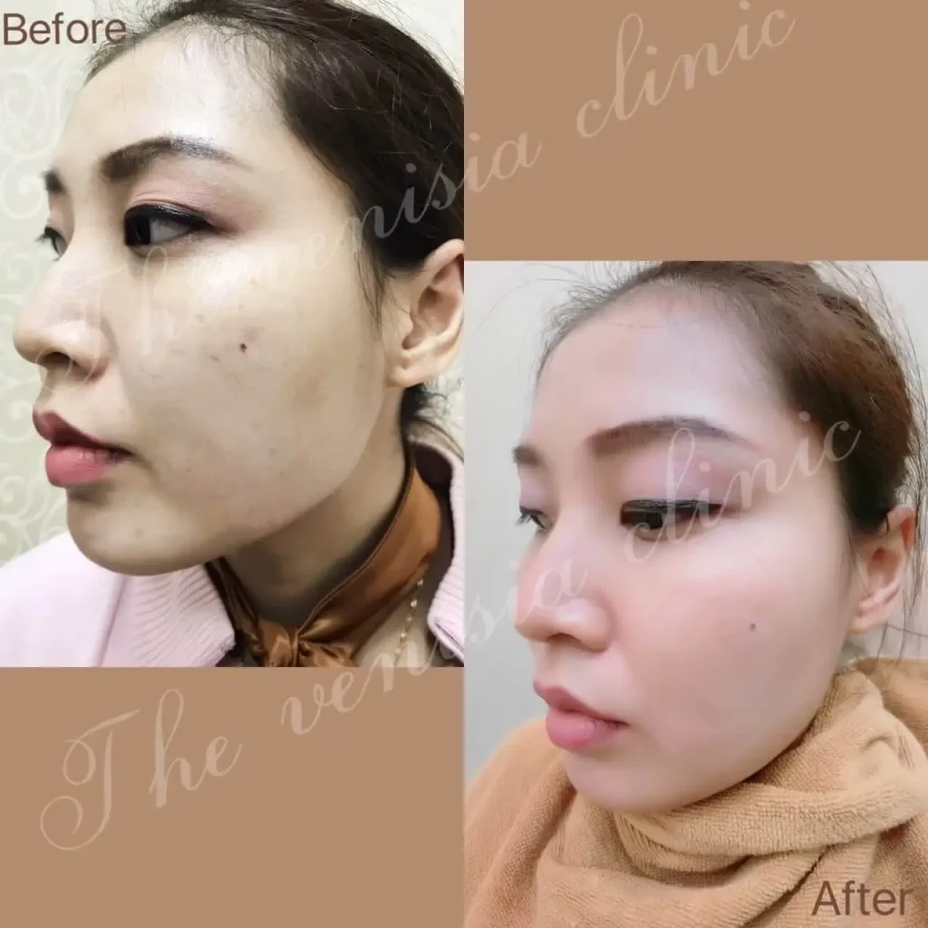 ภาพ รีวิวรักษาหลุมสิว ร่องแก้มดีขึ้นหลังทำ Air Dissector