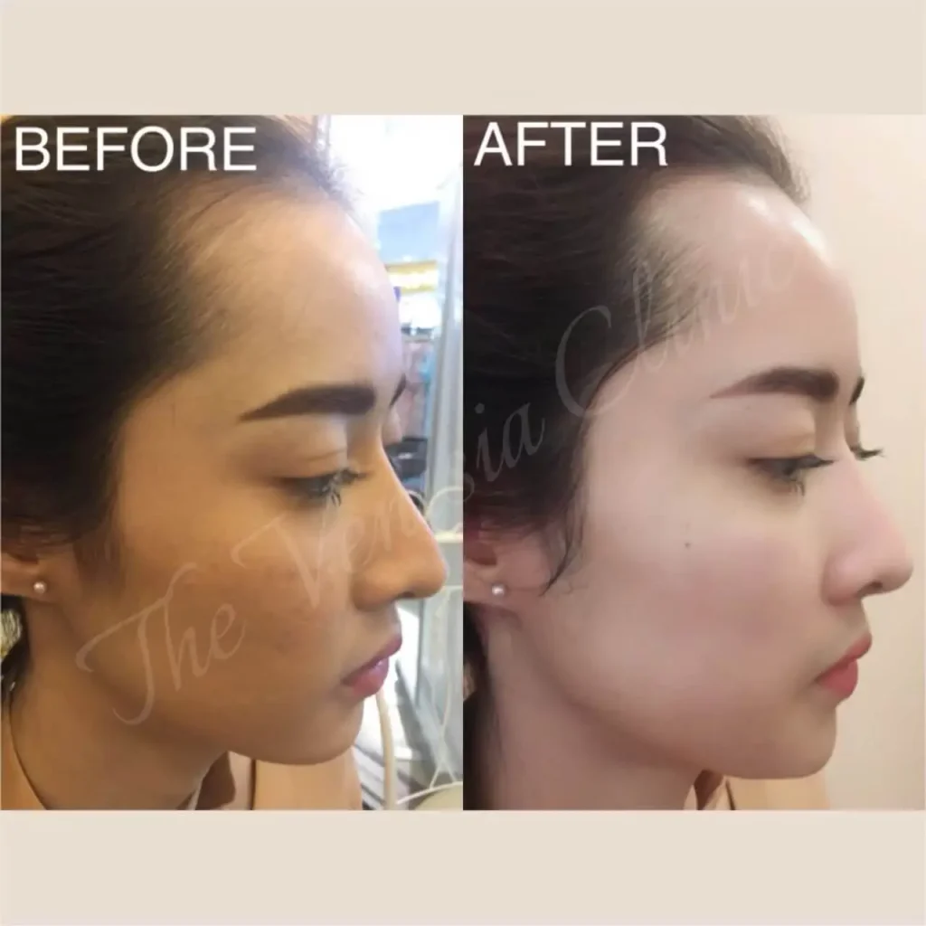 Before After หลุมสิวบริเวณกรอบหน้า ดีขึ้นหลัง Air Dissector