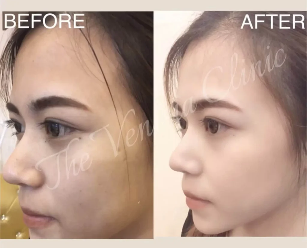 รีวิวเปรียบเทียบหลุมสิวชัดเจน ก่อนและหลัง Air Dissector