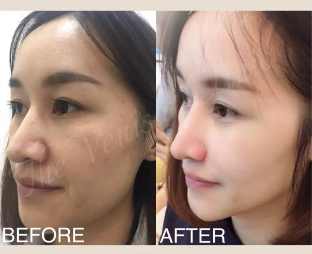 ภาพรีวิวหลุมสิวข้างจมูกตื้นขึ้นหลังทำ Air Dissector