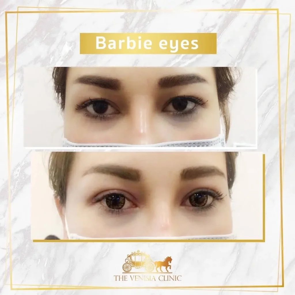 ชั้นตาดูคมชัดขึ้นหลังทำตาสองชั้น เทคนิคเฉพาะของ The Venisia Clinic
