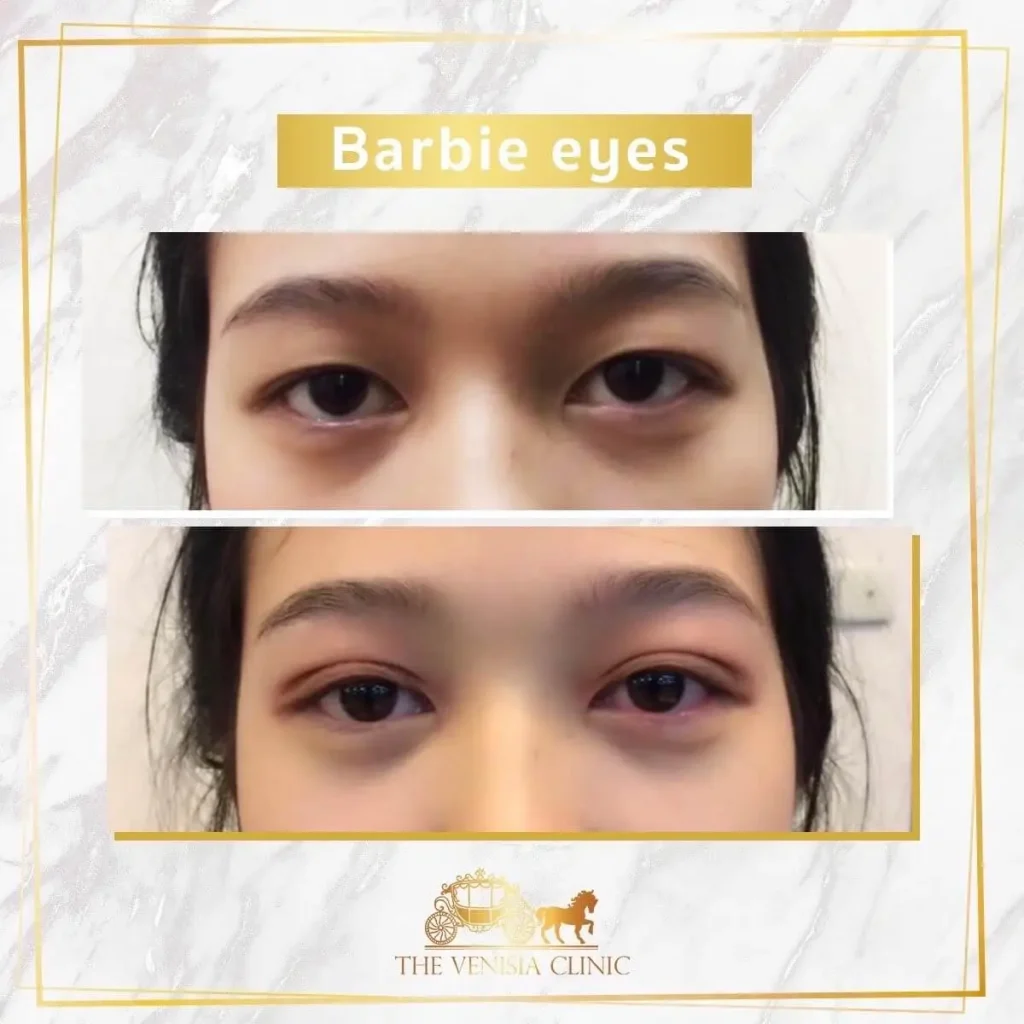 รีวิวทำตาสองชั้น ตาสวยดูละมุนหลังทำ Barbie Eye
