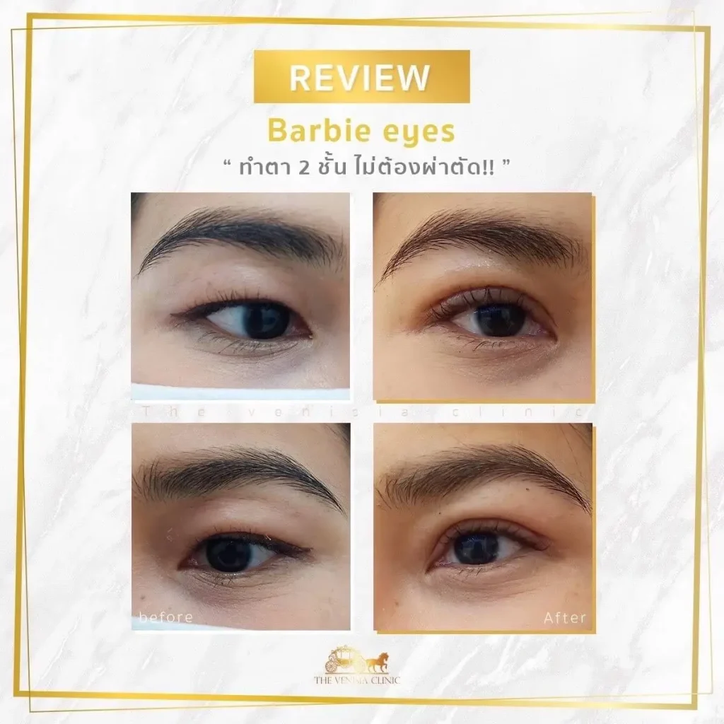 รีวิวทำตาสองชั้น Before–After โปรแกรม Barbie Eye