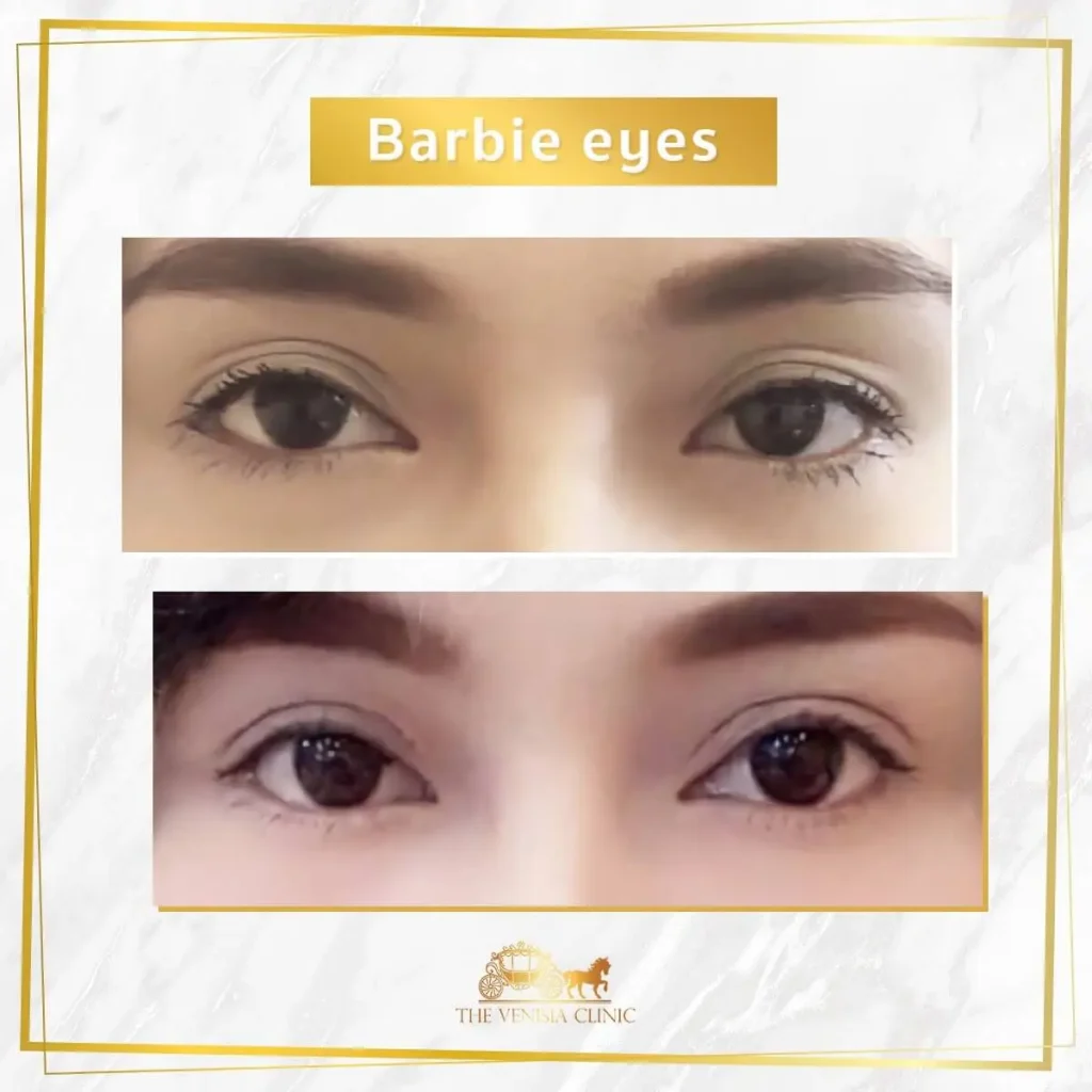 ชั้นตาเปลี่ยนชัดเจนหลังทำ Barbie Eye ไม่ต้องพักฟื้น