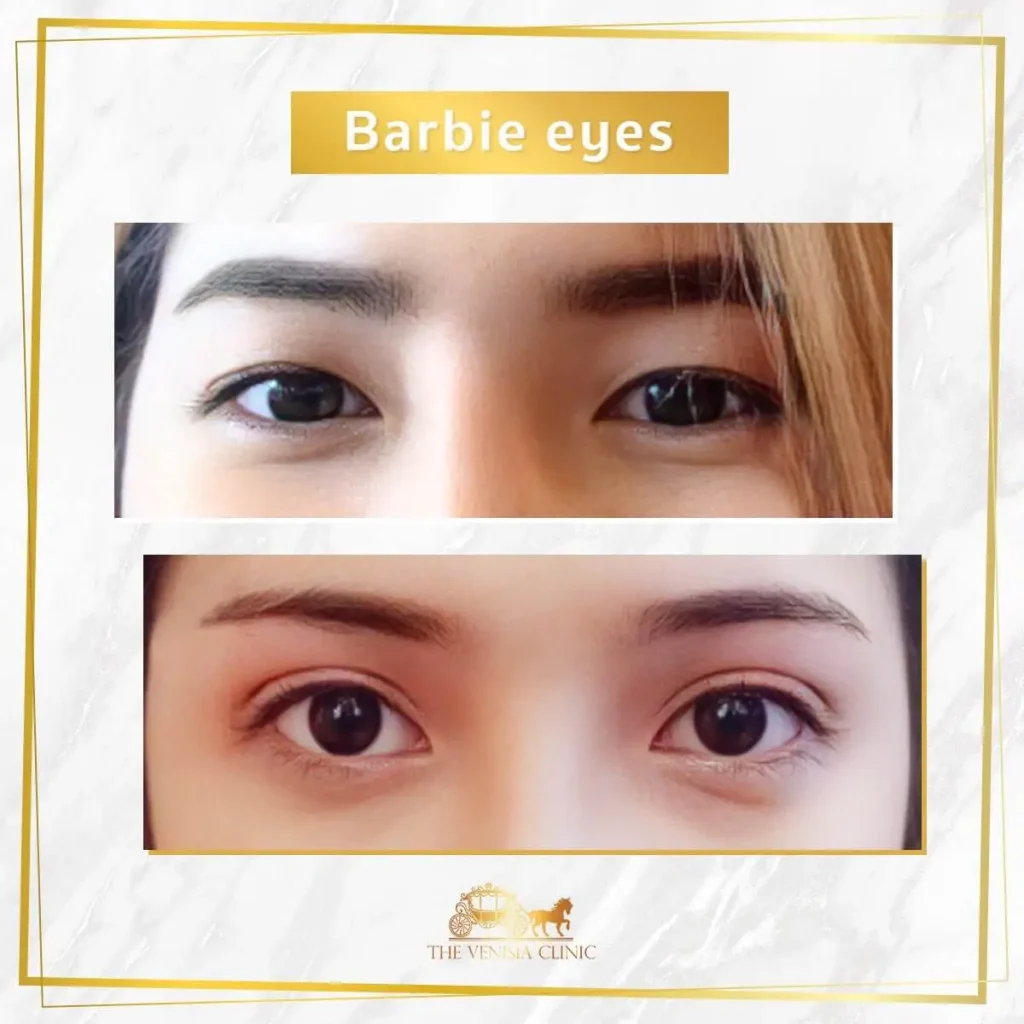 เปรียบเทียบภาพชั้นตาก่อนและหลังทำ Barbie Eye อย่างชัดเจน