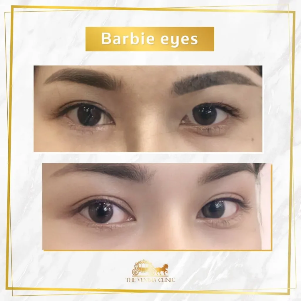 รีวิวทำตาสองชั้น Barbie Eye เคสที่มีตาหลบใน ชั้นตาโค้งสวยขึ้น