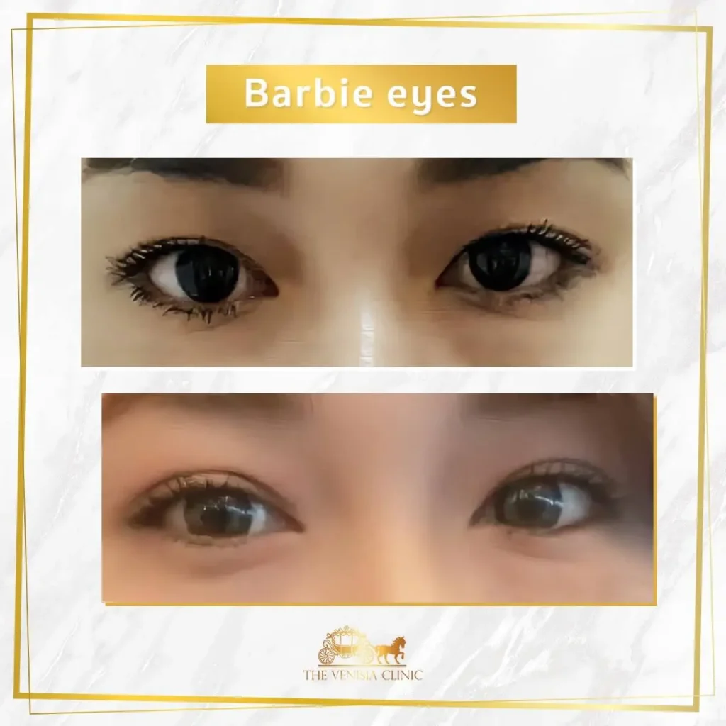 ตาหวานขึ้นด้วยการปรับชั้นตาแบบ Barbie Eyes