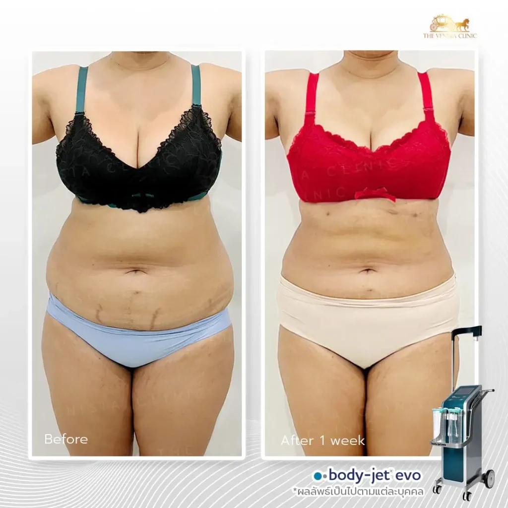 รีวิวดูดไขมัน หน้าท้องคนรูปร่างเล็ก พุงแบนราบ