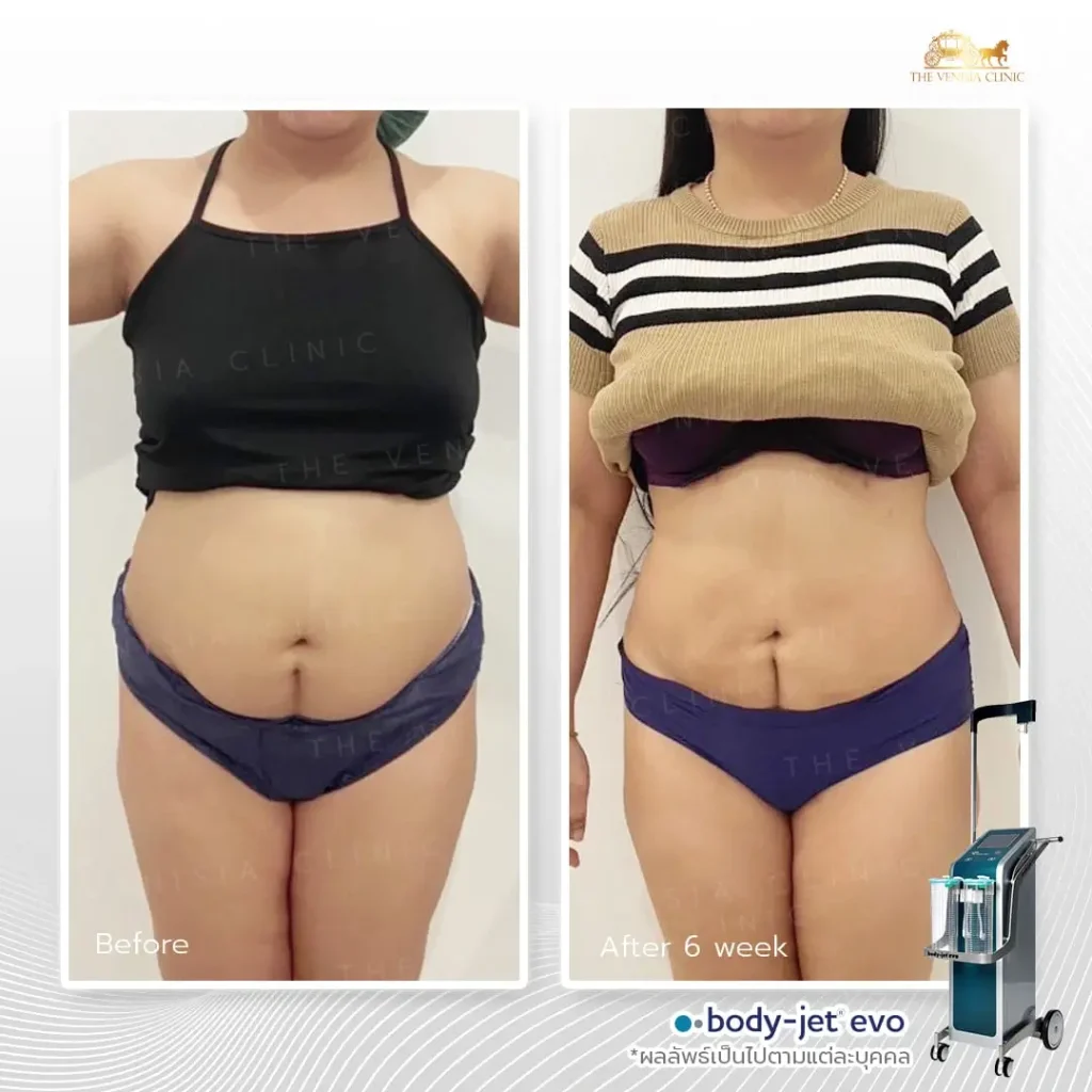 ดึงสัดส่วนให้กระชับขึ้นด้วยเทคโนโลยี Body-Jet Evo