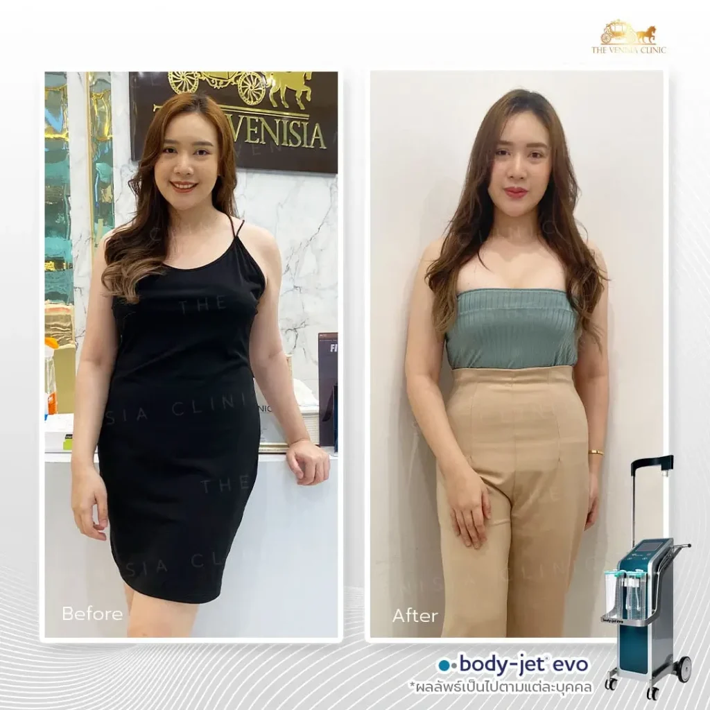 ผลลัพธ์ ดูดไขมัน คนผิวขาว หุ่นเข้ารูปทันที