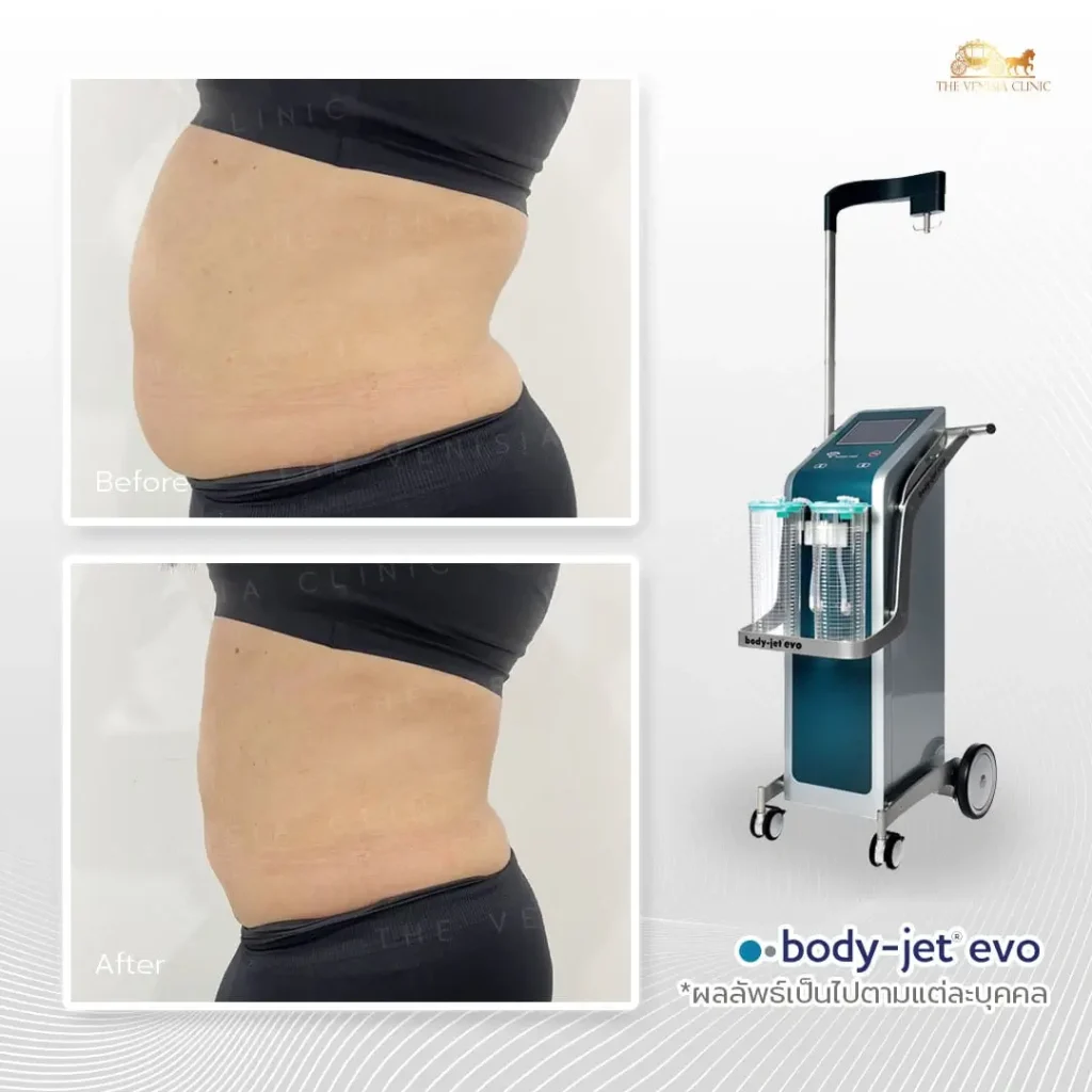 เคสลดไขมันหน้าท้องด้วย Body-Jet Evo