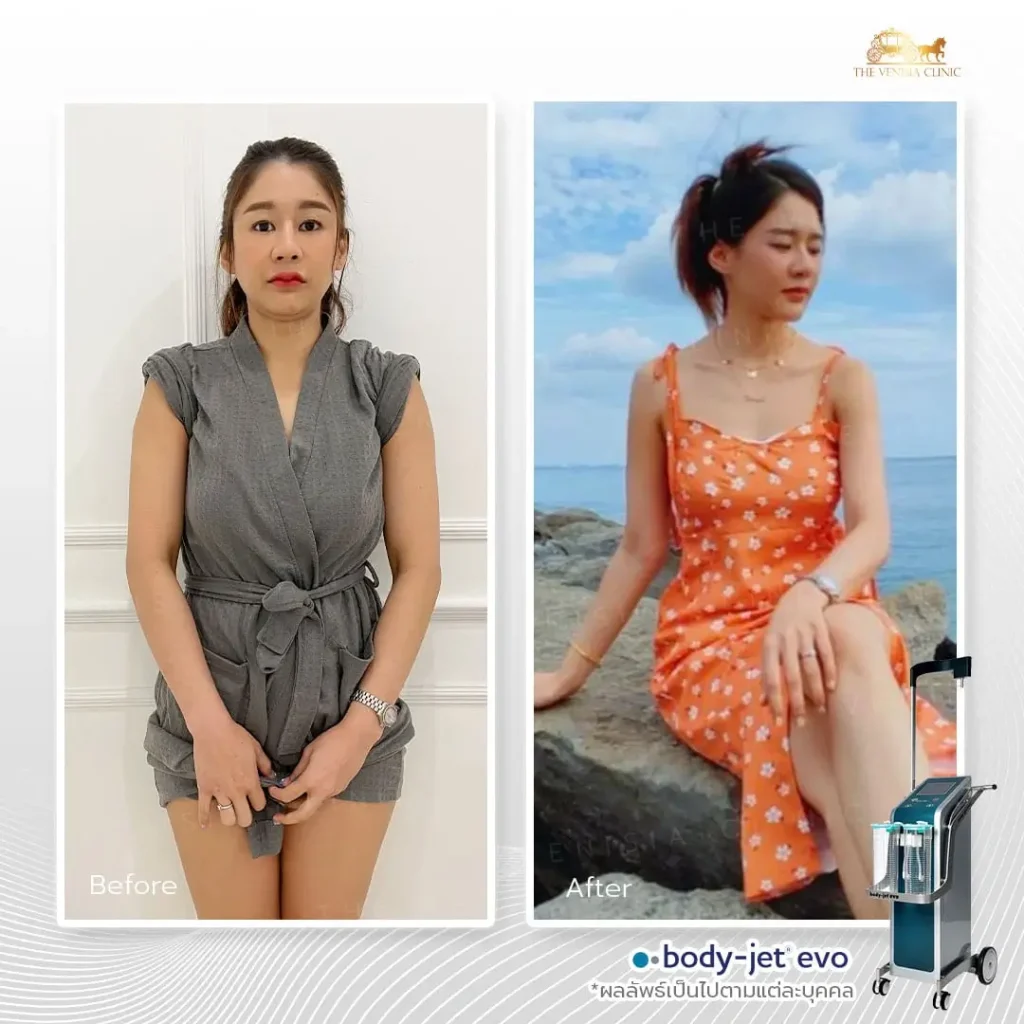 รีวิวดูดไขมัน ผลลัพธ์ก่อนและหลังทำ Body-Jet Evo เคสสาวรูปร่างปกติ