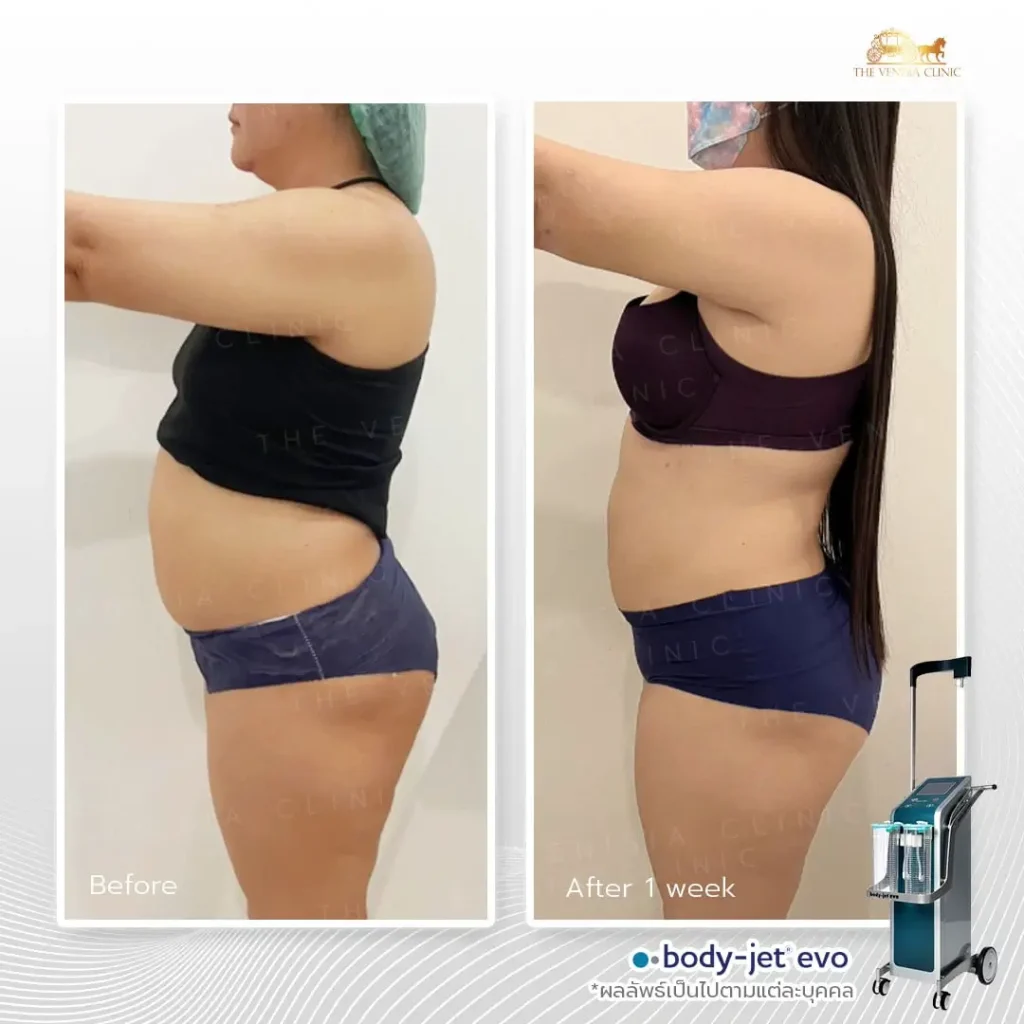 ภาพเปรียบเทียบเคส Before-After แบบ 90 องศา