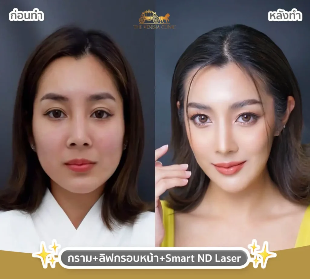 ผลลัพธ์ฉีดโบท็อก และ Needle Lift ช่วยให้ใบหน้าเรียบเนียนและสดใสขึ้น