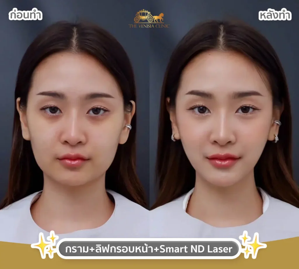 รีวิวฉีดโบท็อก ลดริ้วรอย และปรับรูปหน้าให้ดูละมุนขึ้น