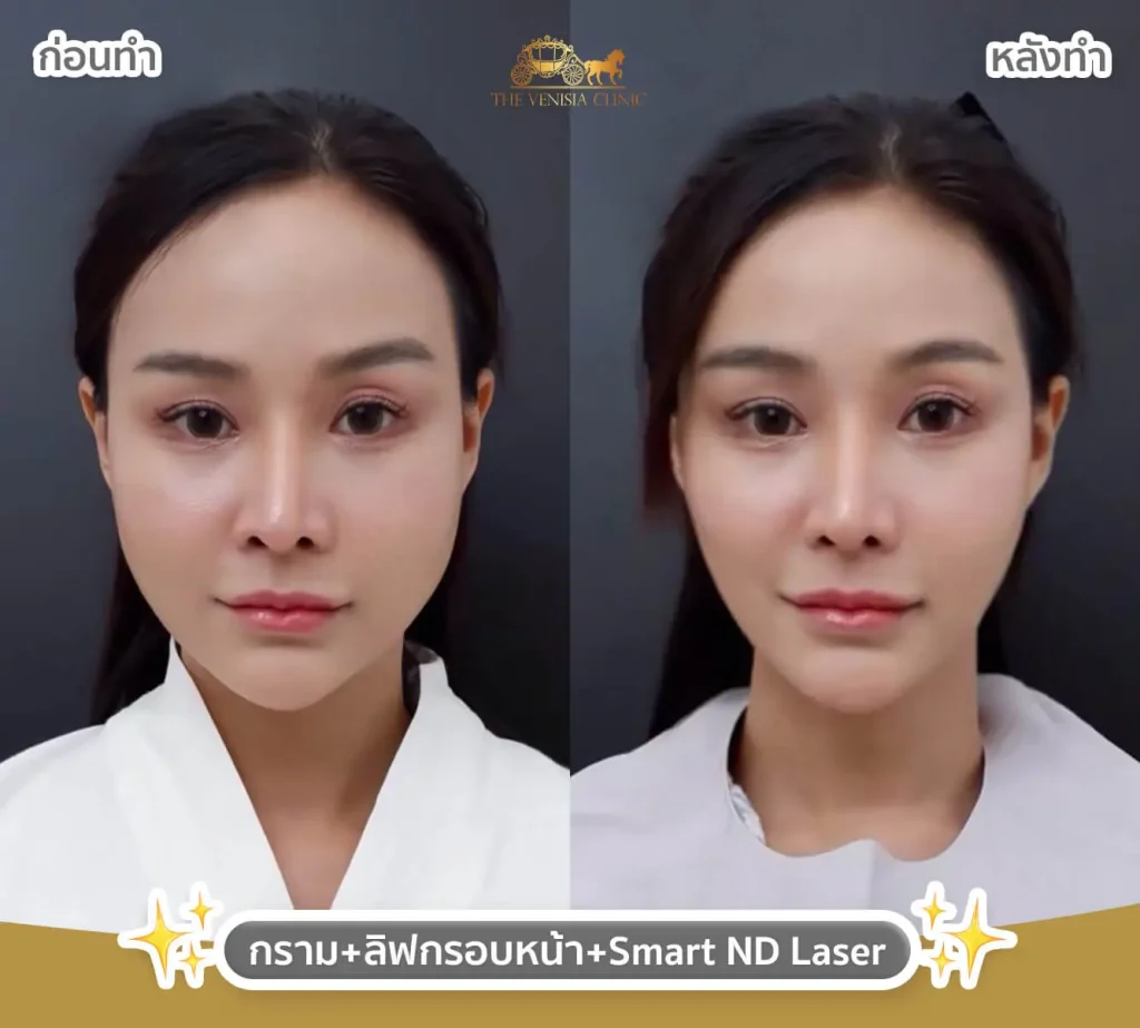 รีวิวฉีดโบท็อก พร้อมเลเซอร์ ยกกระชับและลดริ้วรอยในขั้นตอนเดียว