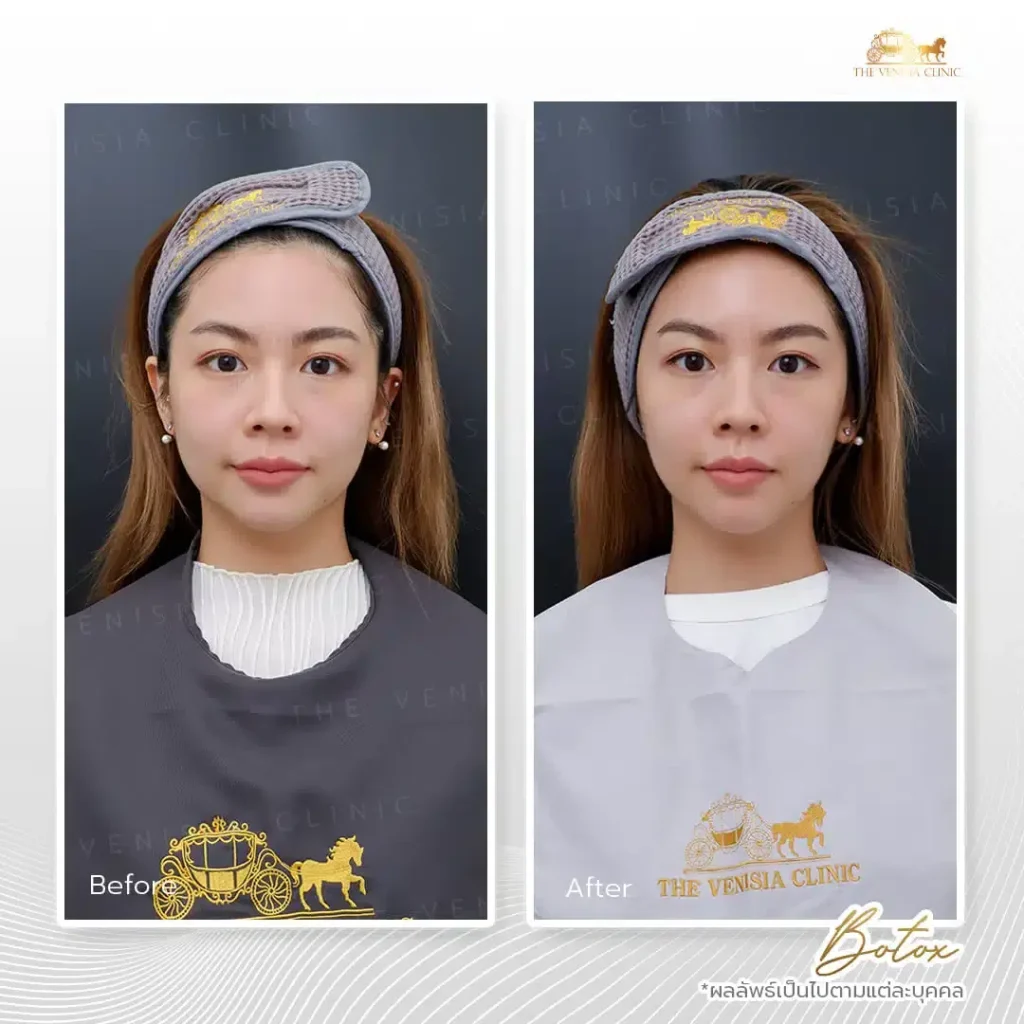 รีวิวฉีดโบท็อก ปรับรูปหน้า จากเคสจริงที่ The Venisia Clinic