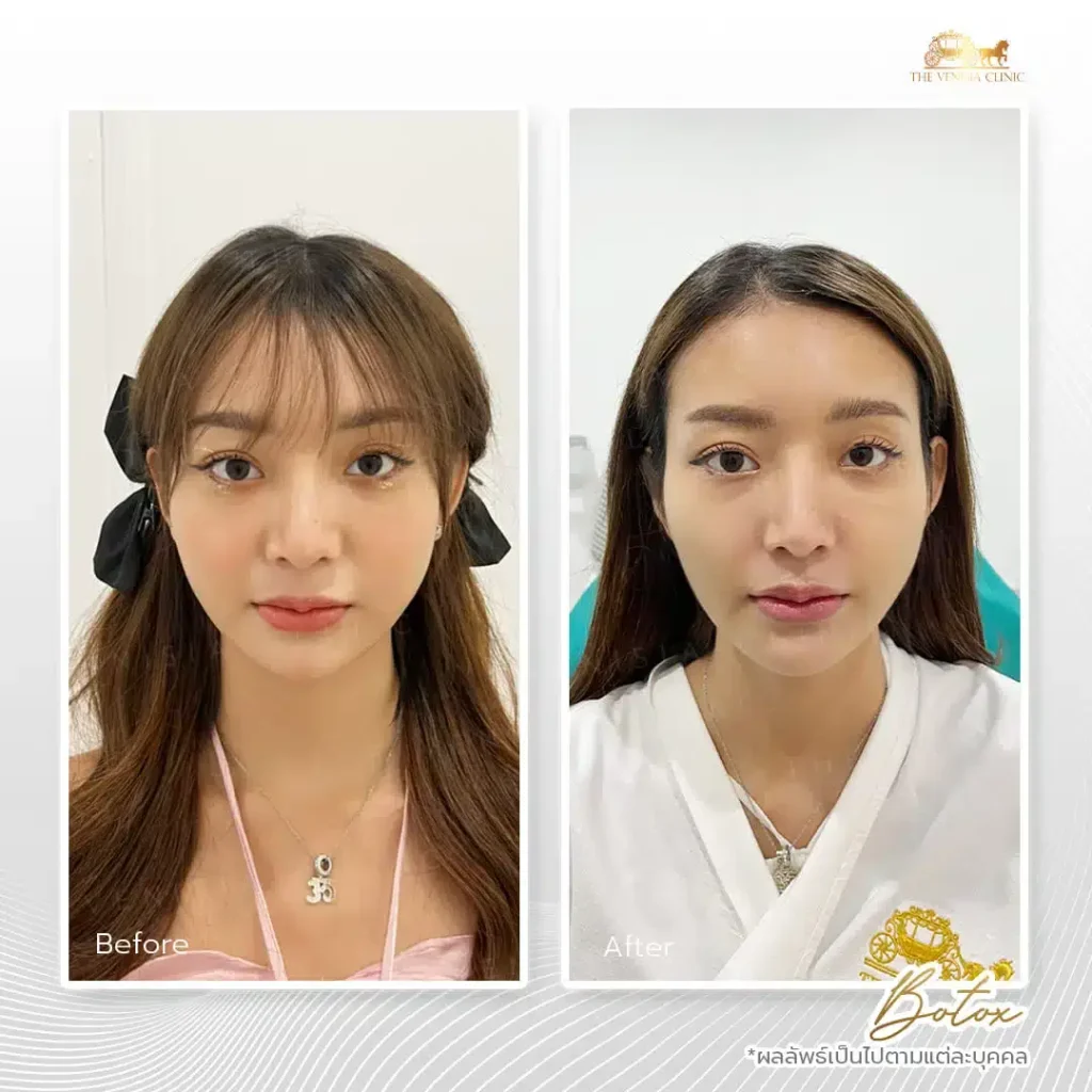 ภาพก่อนและหลังทำโบท็อก ลดริ้วรอยอย่างเป็นธรรมชาติ