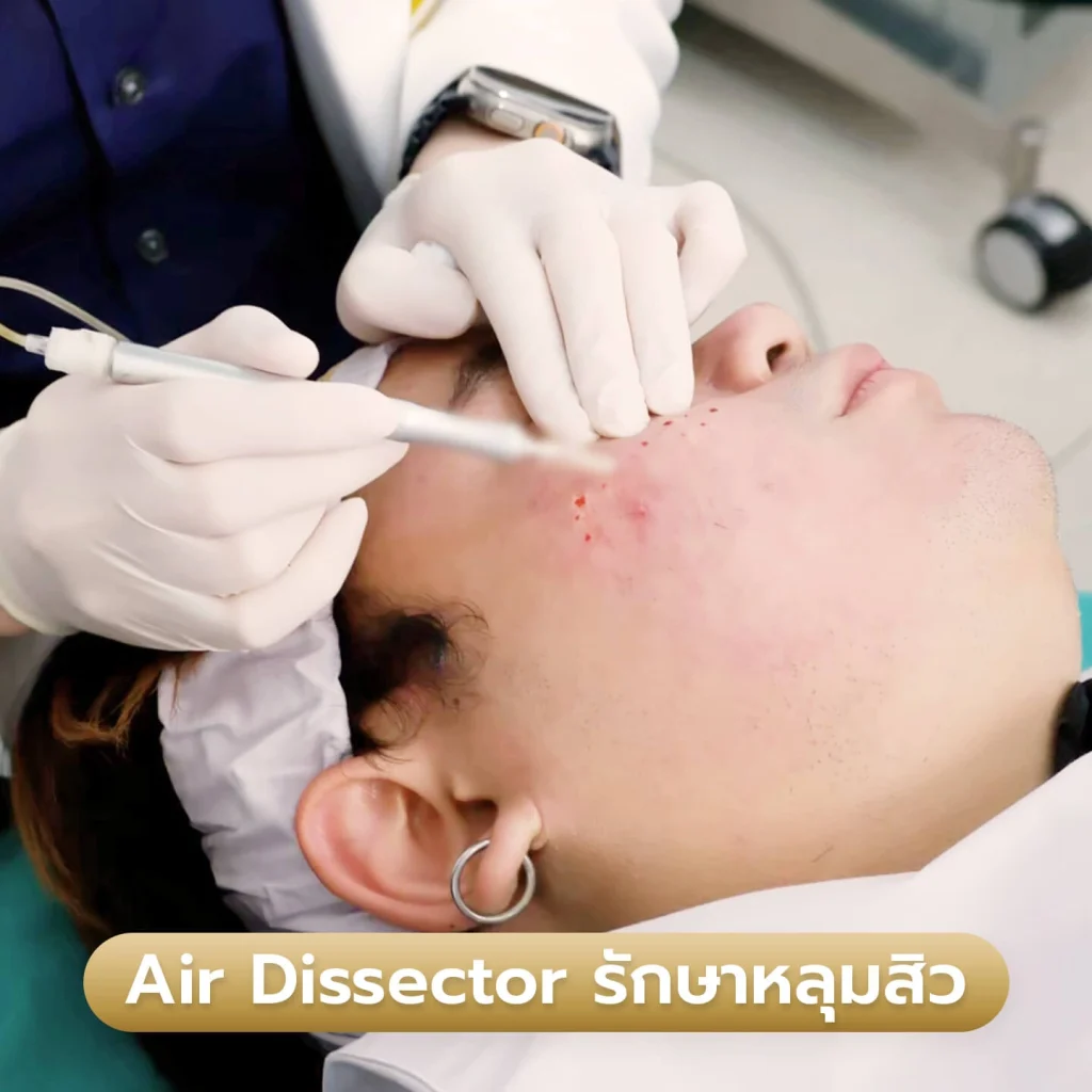 บริการ รักษาหลุมสิว Air Dissector