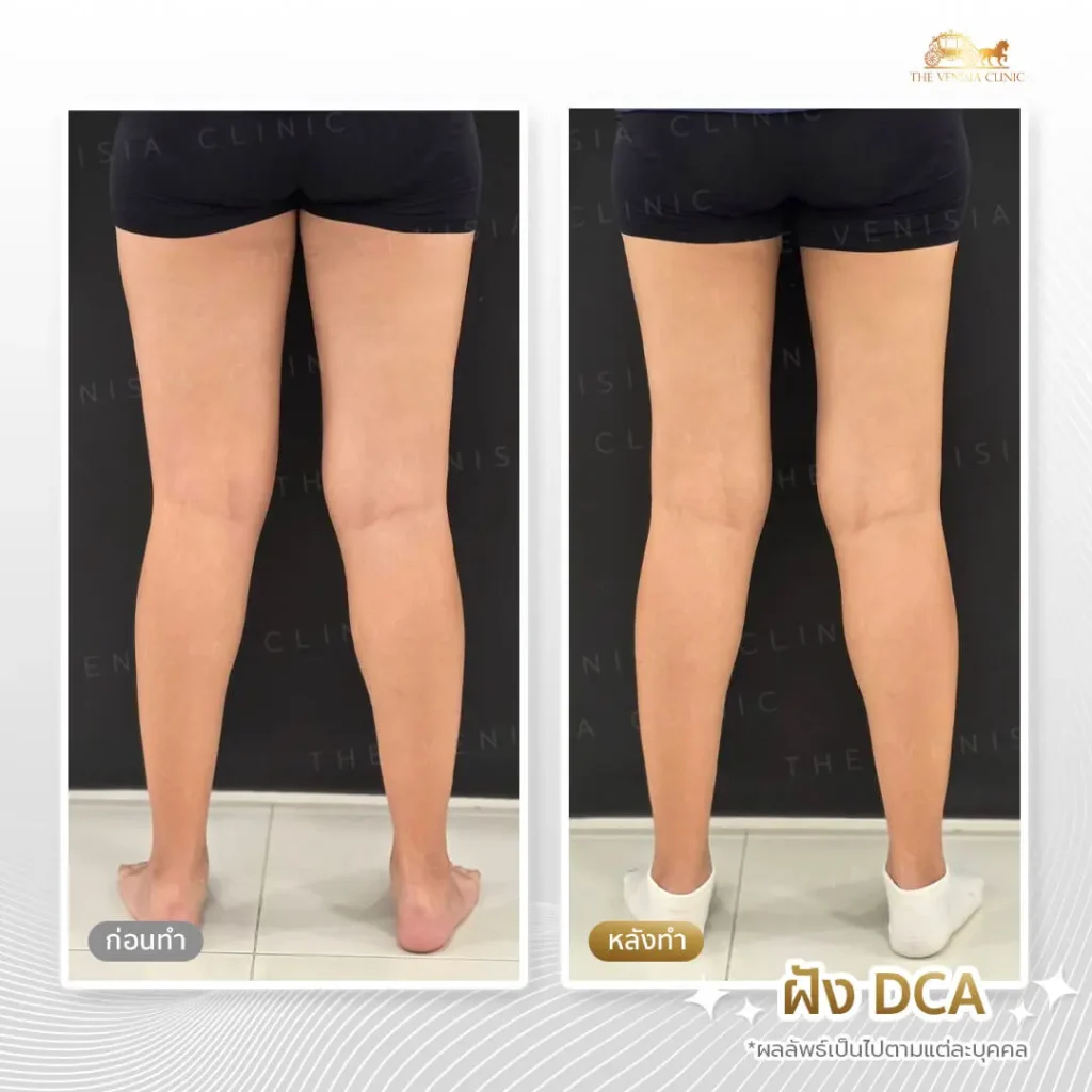 รีวิวก่อน-หลังลดไขมันต้นขาและเซลลูไลท์