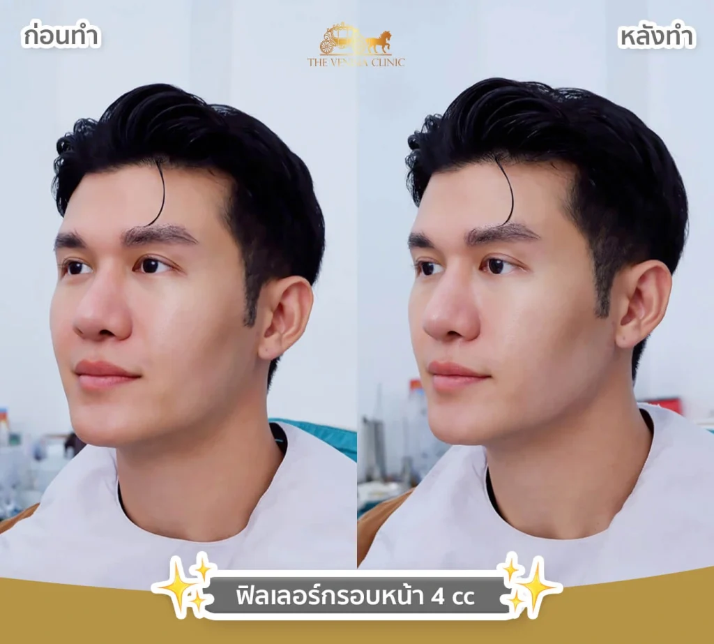 ปรับมิติใบหน้าด้วยฟิลเลอร์ 1 cc ให้หน้าดูละมุนขึ้น