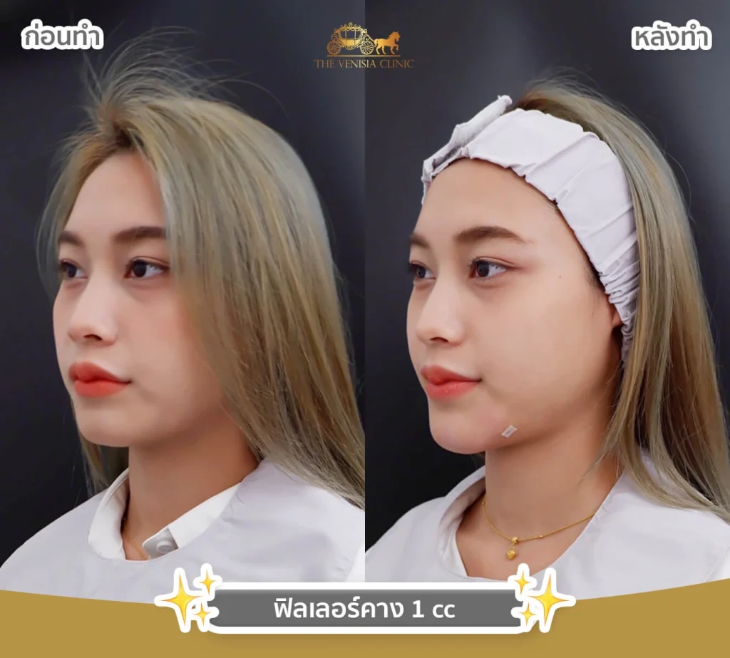 หลังฉีดฟิลเลอร์ 1 cc ปรับรูปหน้าให้สมส่วน