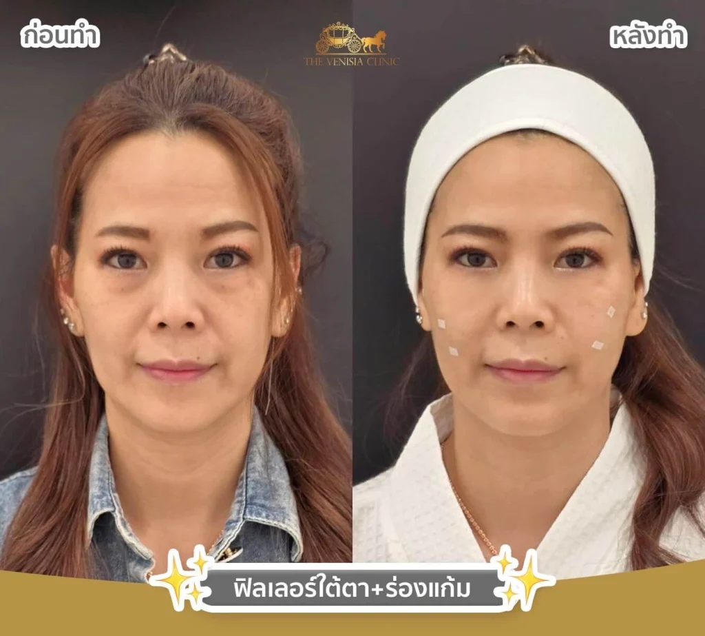 หลังฉีดฟิลเลอร์ใต้ตาและร่องแก้ม ลดอายุอย่างเห็นได้ชัด