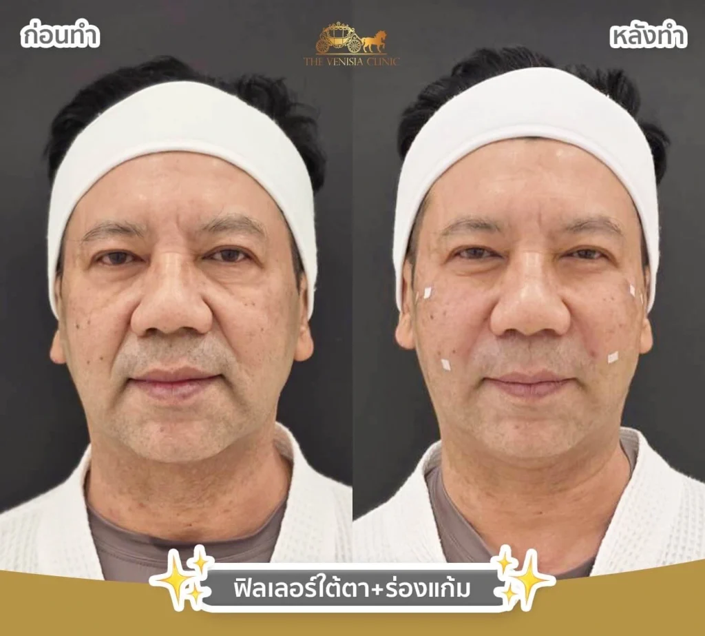 ฉีดฟิลเลอร์กรอบหน้า 4 cc ใบหน้าคม ชัดเจนขึ้นทันที