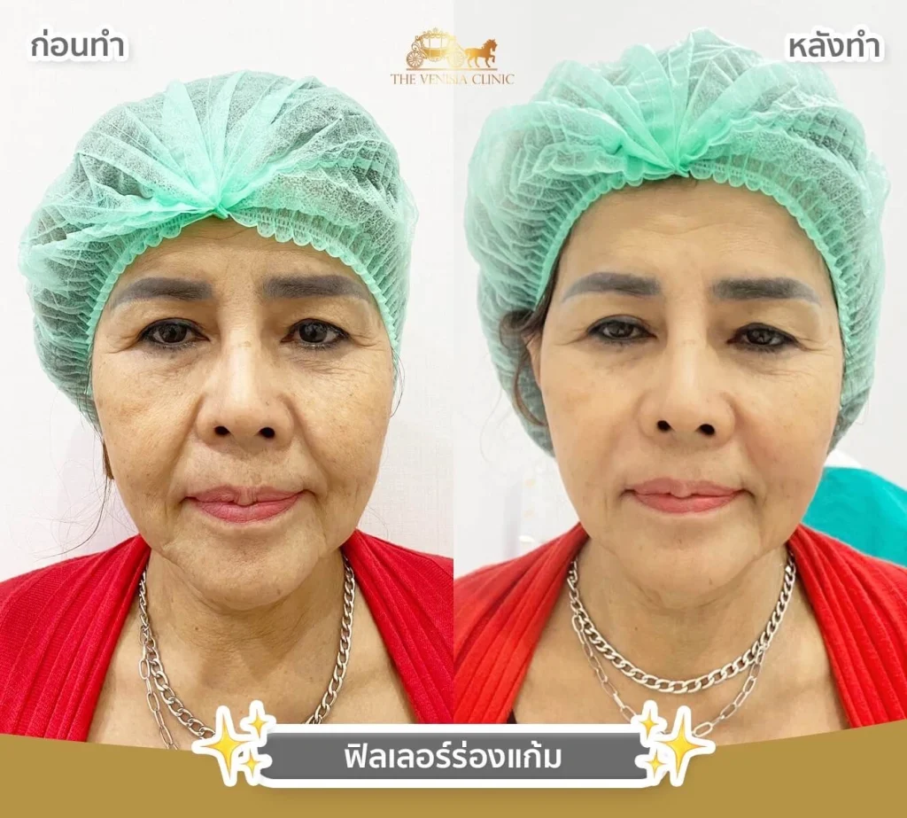 หลังฉีดฟิลเลอร์ใต้ตา ลดความหมองคล้ำ ใบหน้าสดใสขึ้น