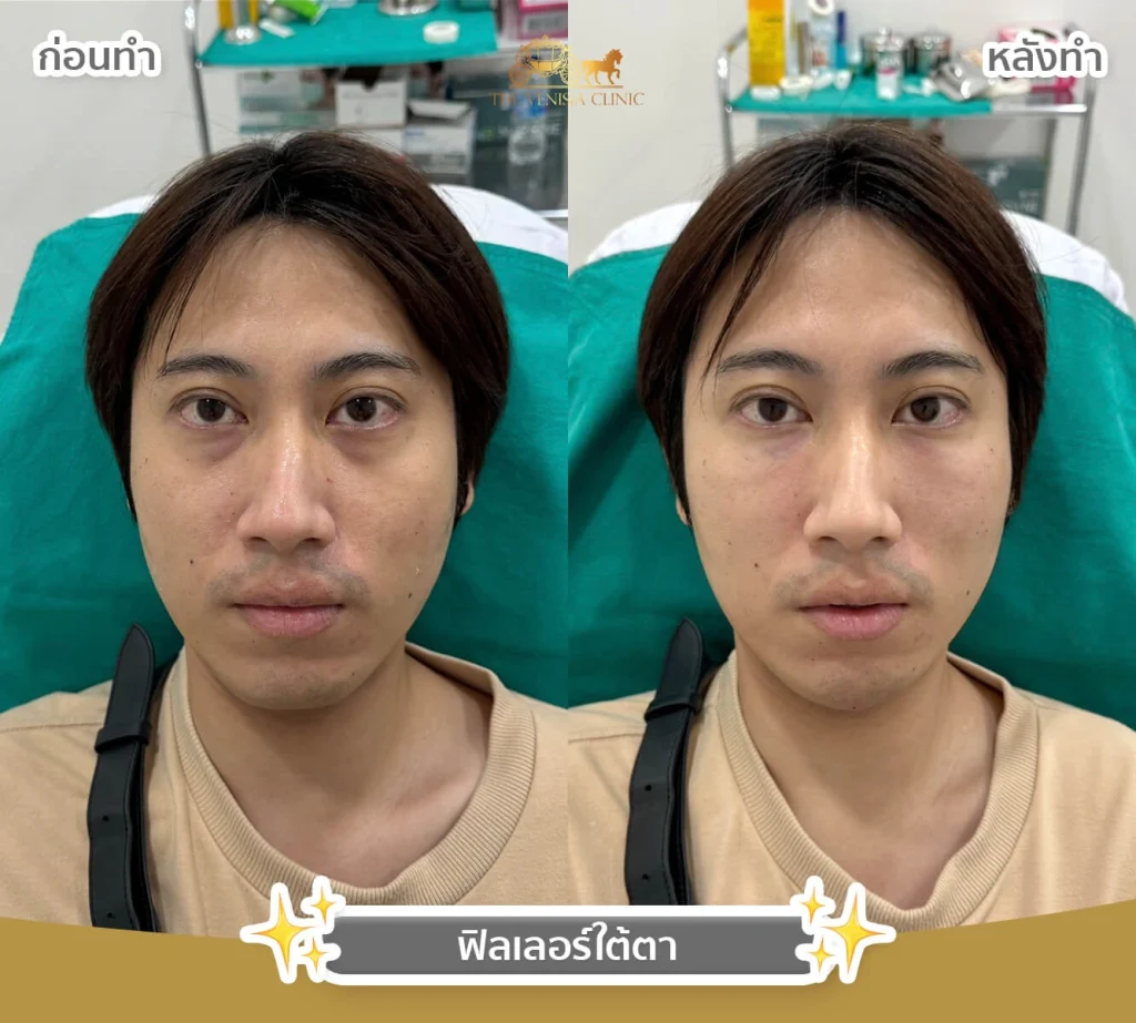 ใบหน้าอิ่มฟูขึ้นหลังฉีดฟิลเลอร์
