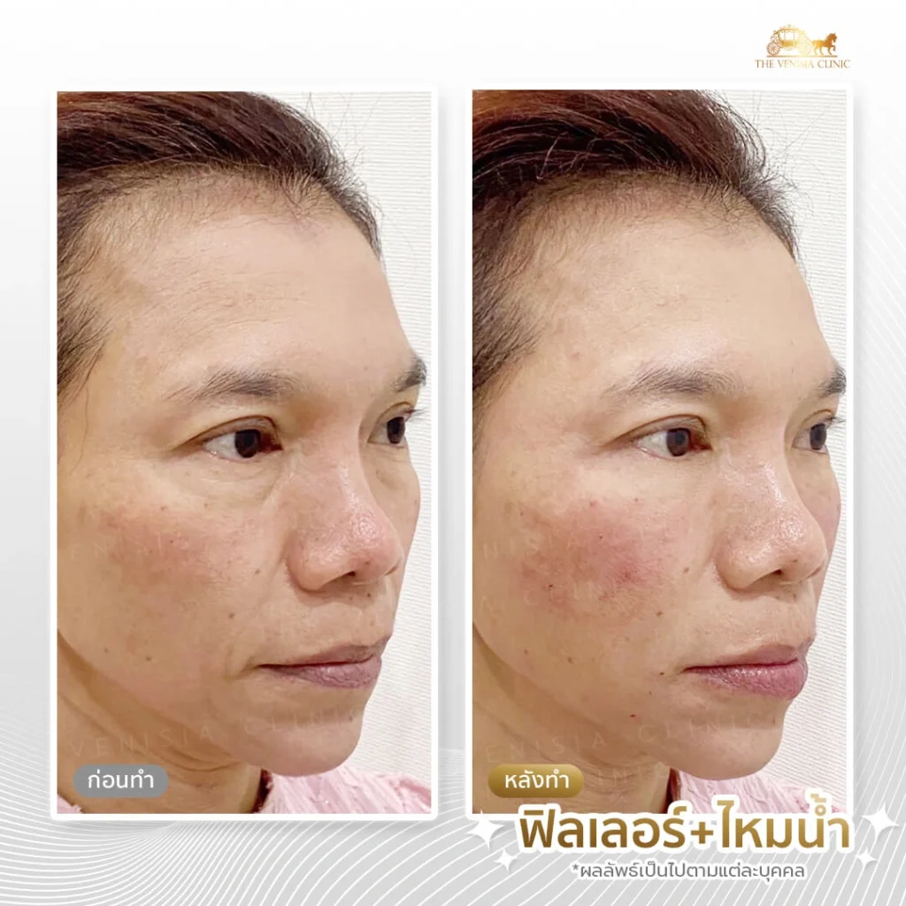 รีวิวหลังฉีดฟิลเลอร์ใต้ตาและร่องแก้ม หน้าดูสดใสขึ้น