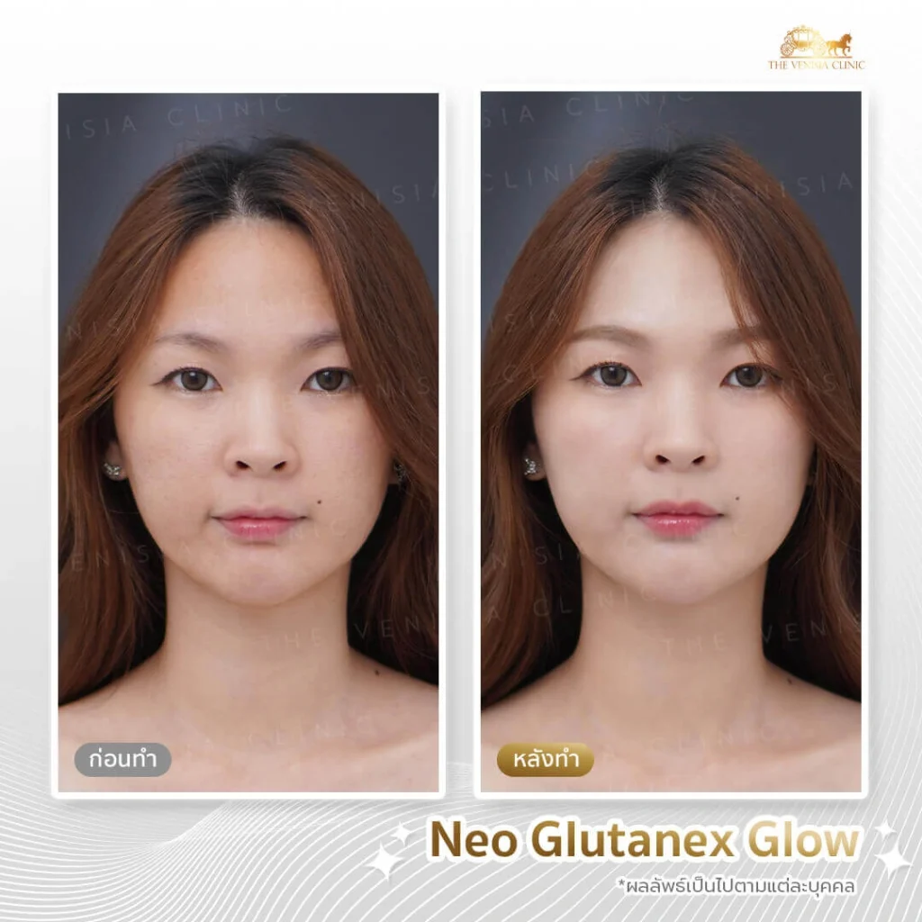 รีวิวเมโสหน้าใส ด้วยโปรแกรม Neo Glutanex Glow ใบหน้าดูกระจ่างใสขึ้น