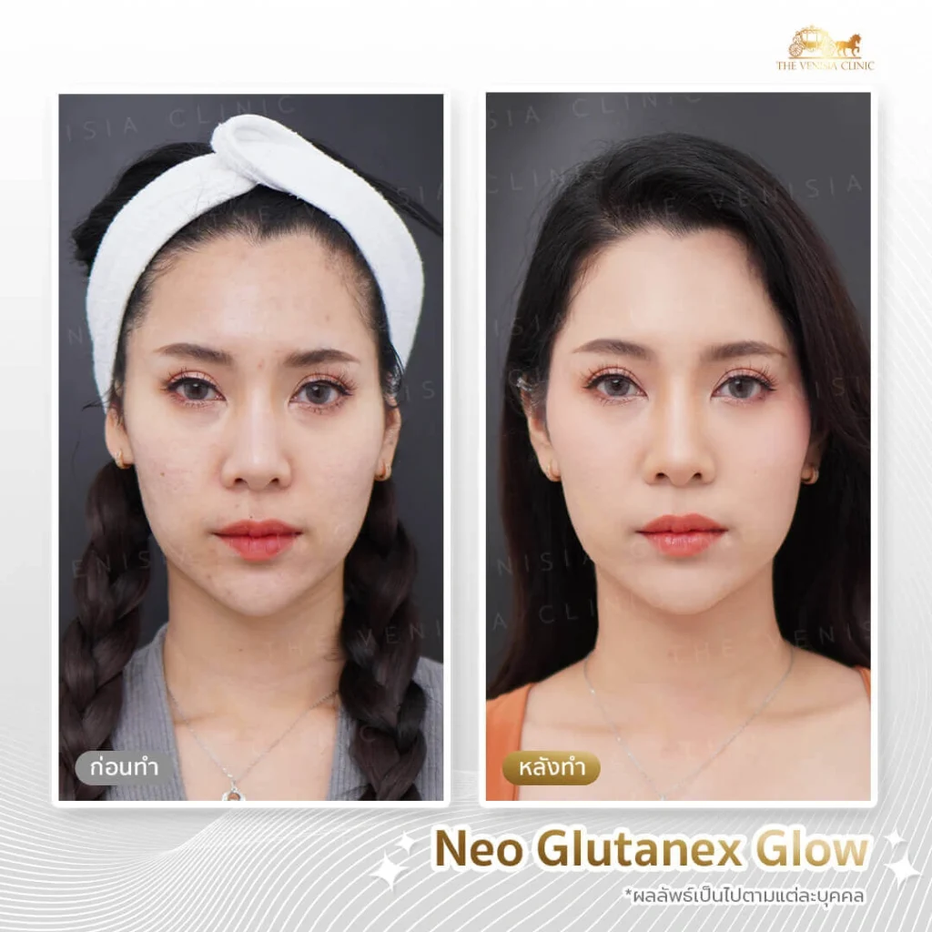 รีวิวเมโสหน้าใส ลดรอยแดง สีผิวสม่ำเสมอขึ้นด้วย Neo Glutanex Glow