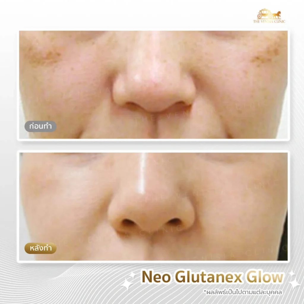 ลดจุดด่างดำและผิวหมองคล้ำ รีวิวเมโสหน้าใส เห็นผลจริง