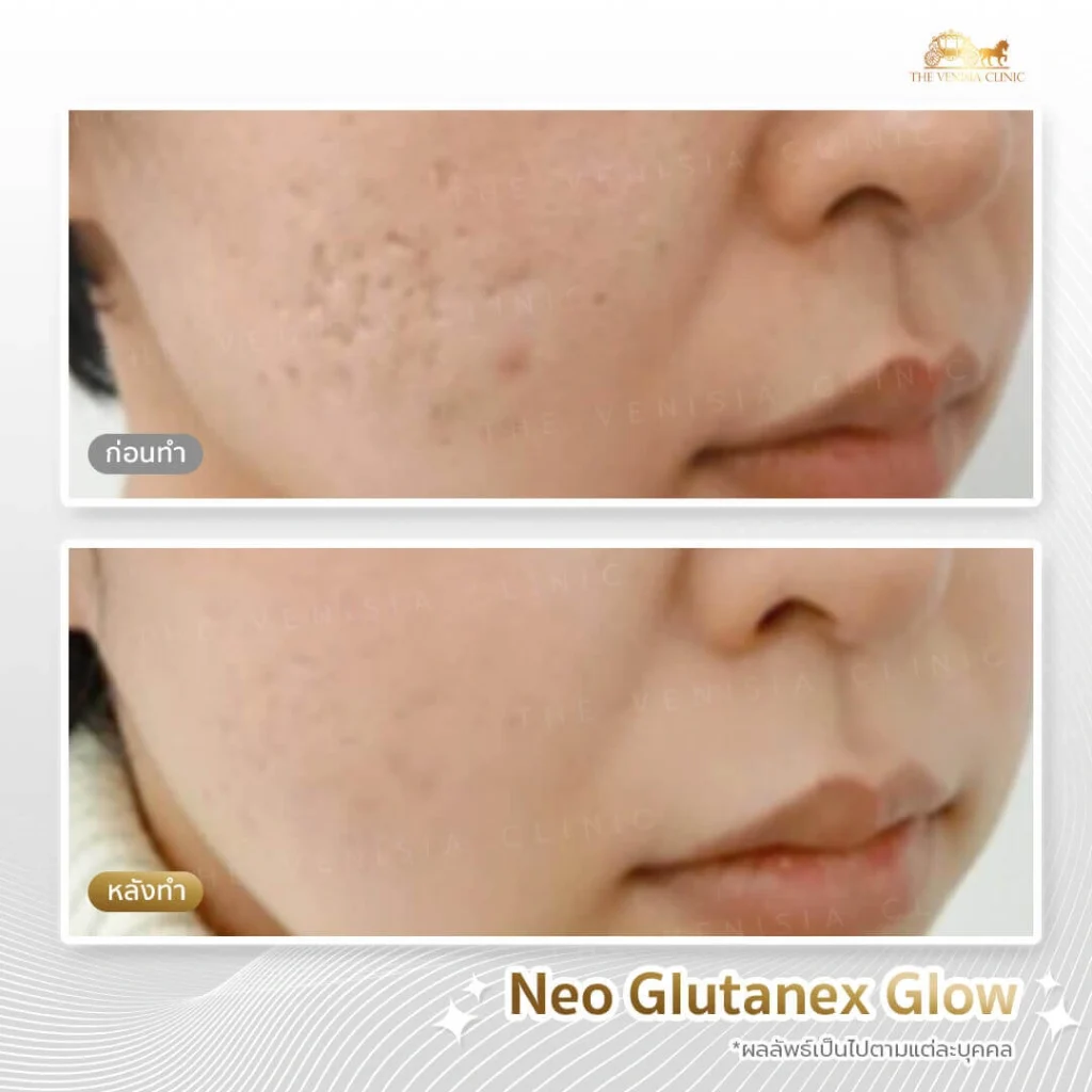 ปรับรอยสิวและหลุมสิวให้ดูตื้นขึ้นด้วยการทำเมโสหน้าใส
