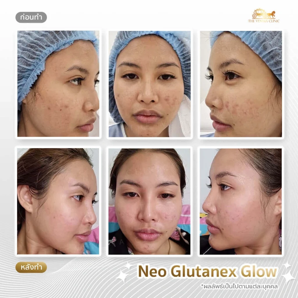 รีวิวเมโสหน้าใส ในคนเป็นสิว ผิวดูเรียบเนียนขึ้น