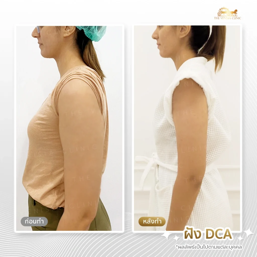 รีวิว DCA ลดไขมันต้นแขน ทำให้รูปร่างดูสมส่วนขึ้น