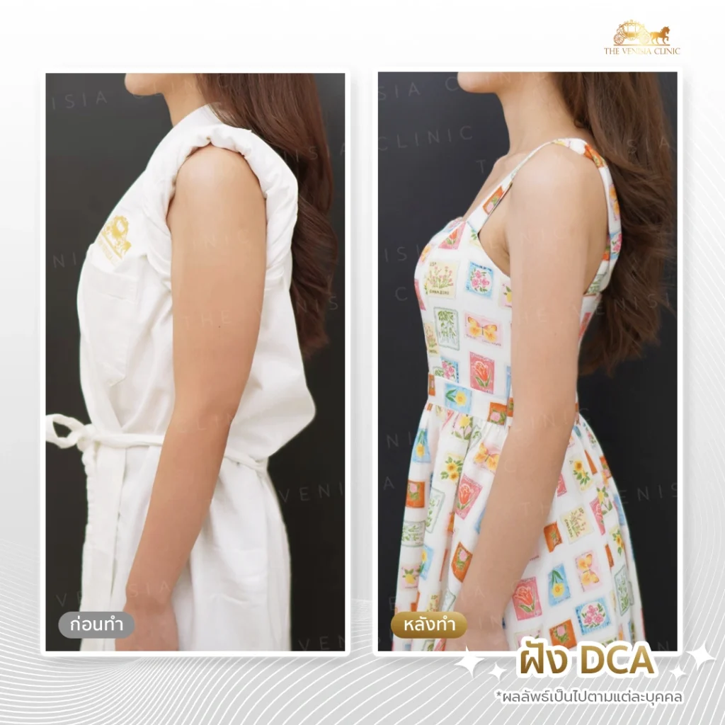 รีวิว DCA ปรับรูปร่างแขนเรียวสวย แม้ใส่เสื้อแขนกุด