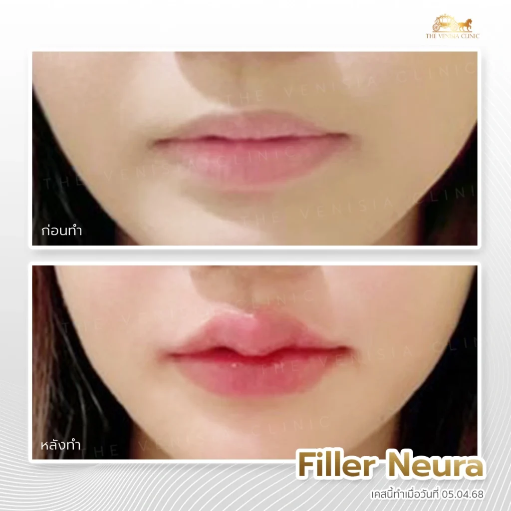 รีวิวฟิลเลอร์ปาก Neuramis ปากอวบอิ่มเป็นทรงสวยดูละมุน