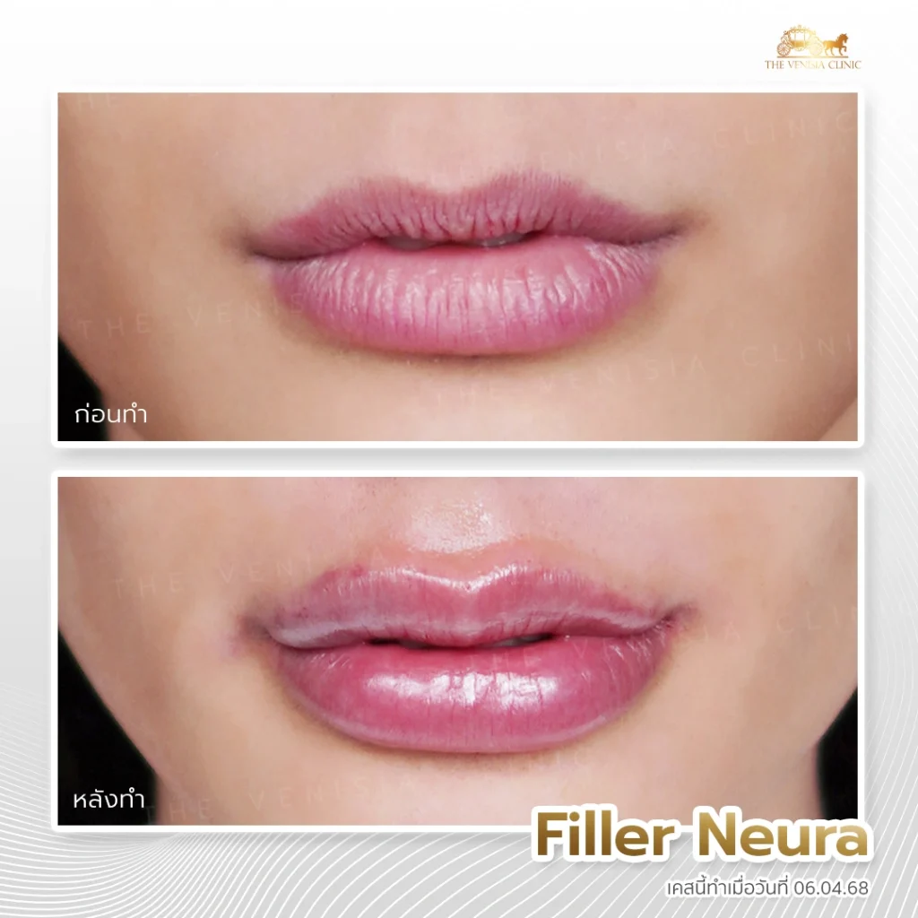 รีวิวฟิลเลอร์ปาก Neuramis ช่วยปรับรูปปากให้นุ่มฟูอย่างเป็นธรรมชาติ