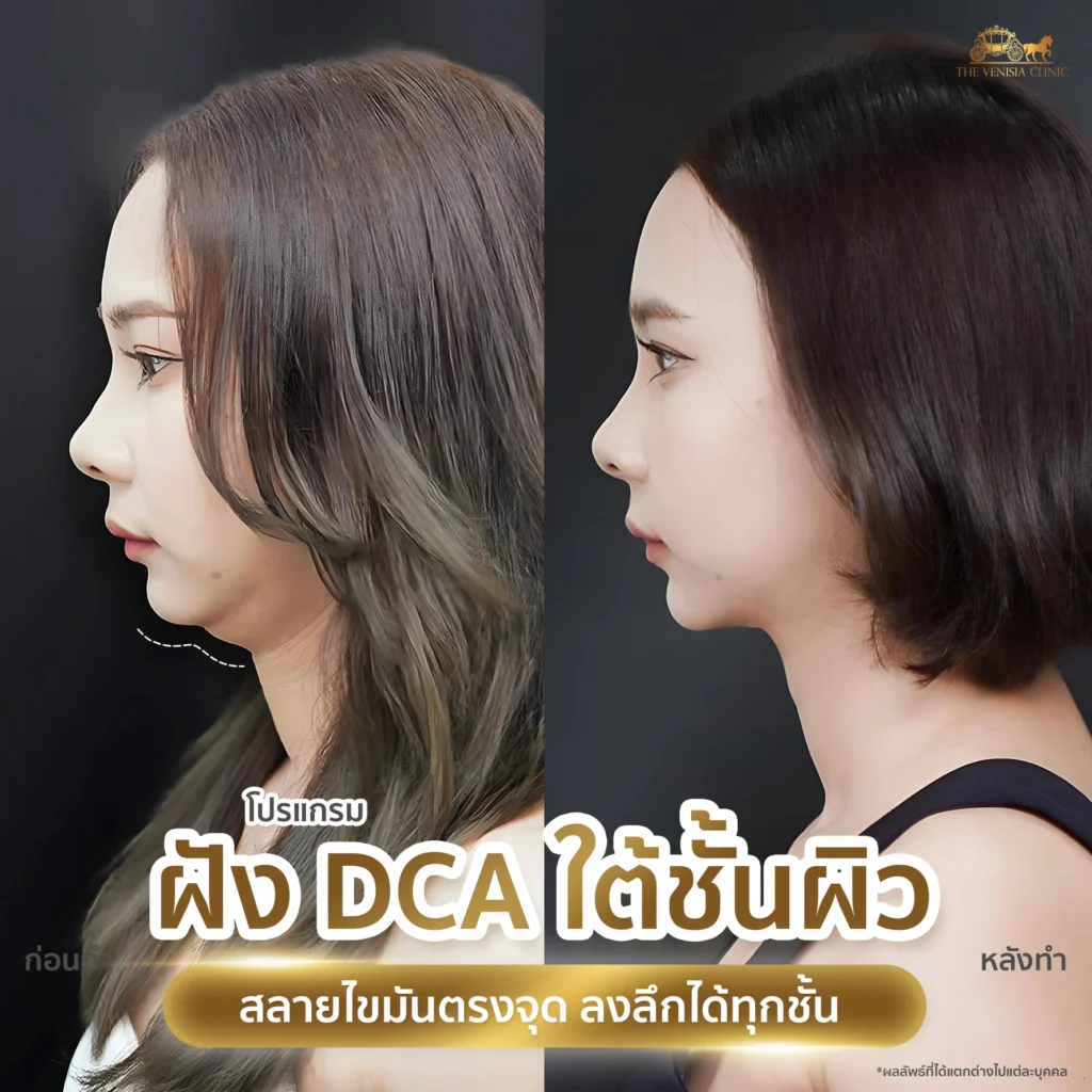 ภาพเปรียบเทียบก่อนหลังทำ เห็นผลในมุมด้านข้าง