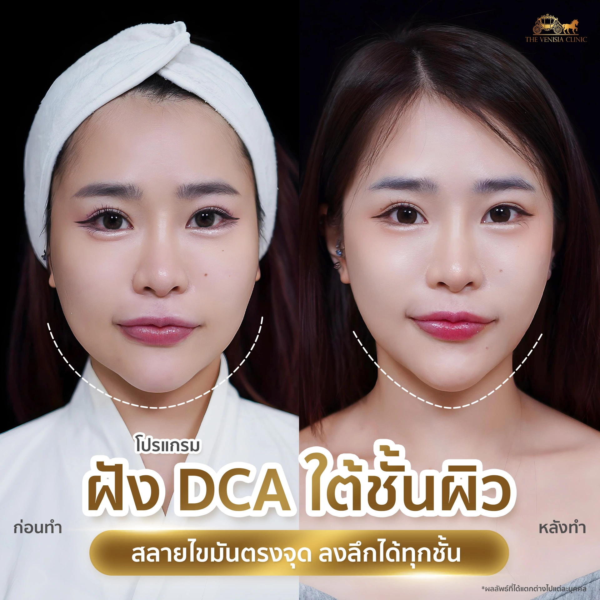 รีวิว DCA ลดแก้มและปรับรูปหน้า เห็นผลลัพธ์ตั้งแต่ครั้งแรก