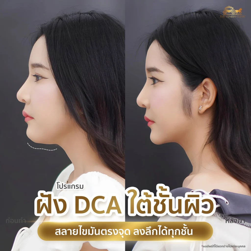 คนแก้มเยอะ ช่วยยกกระชับและปรับหน้าให้สมดุล