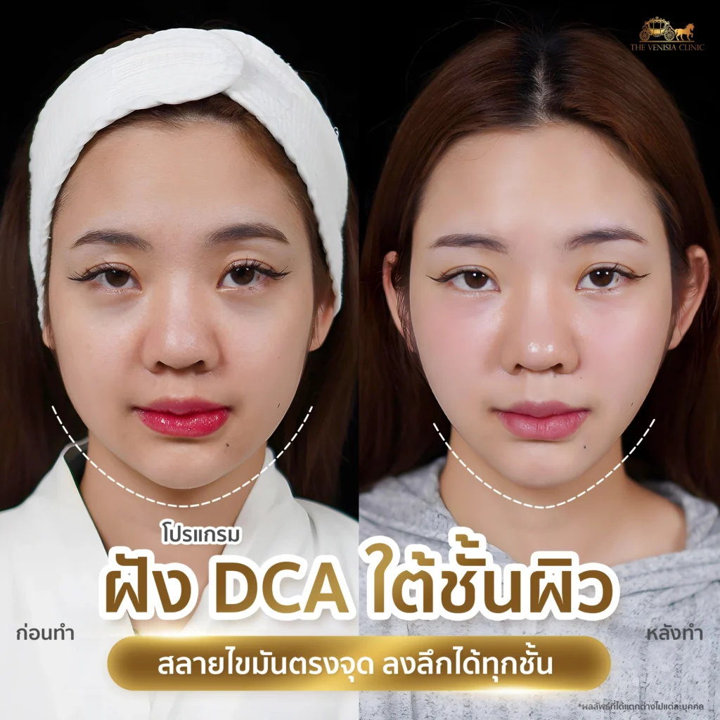 กระชับแก้ม ลดไขมันหน้า เหมาะกับคนแก้มเยอะ