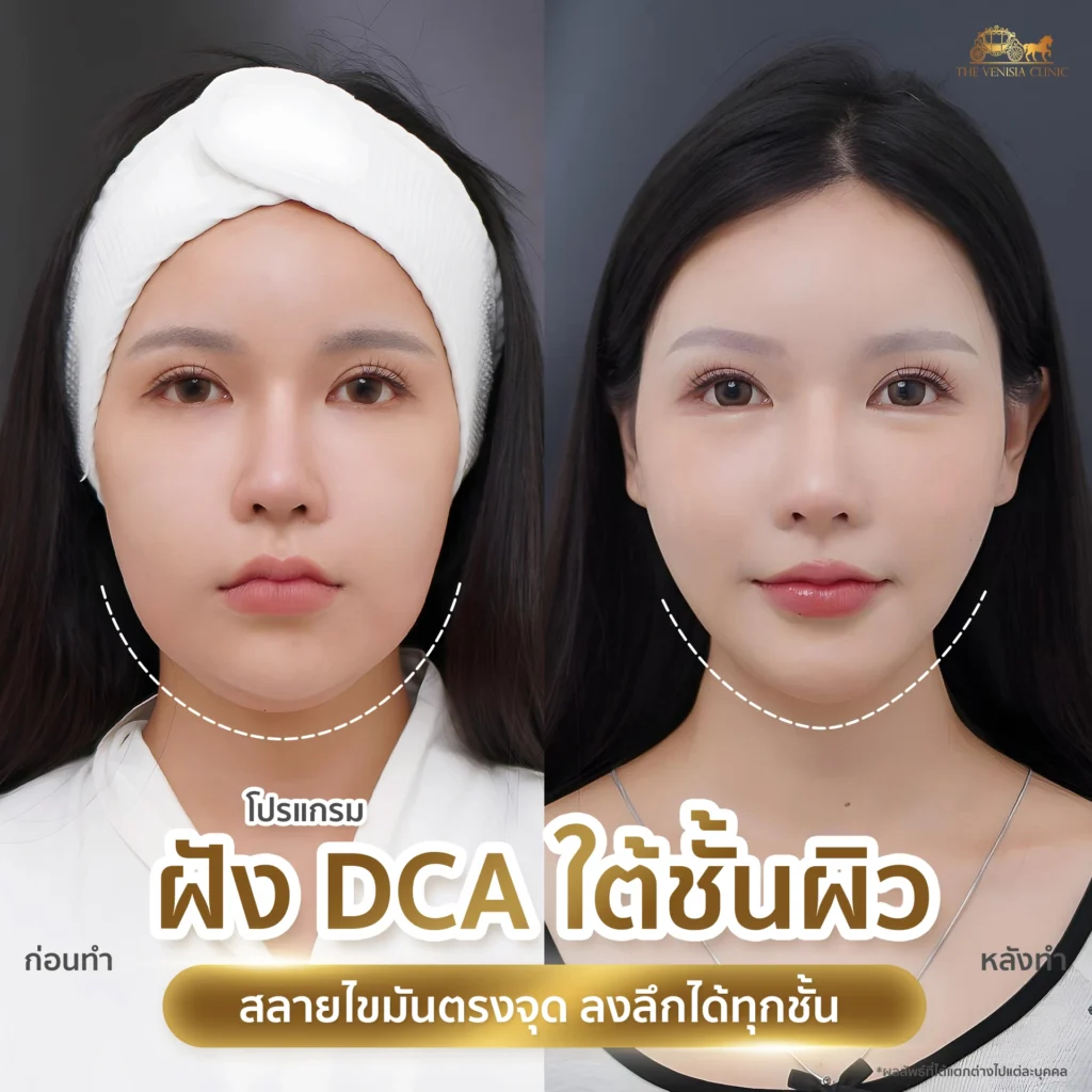 ผลลัพธ์หลังทำ DCA ใต้ค้างสำหรับคนที่มีไขมันสะสม