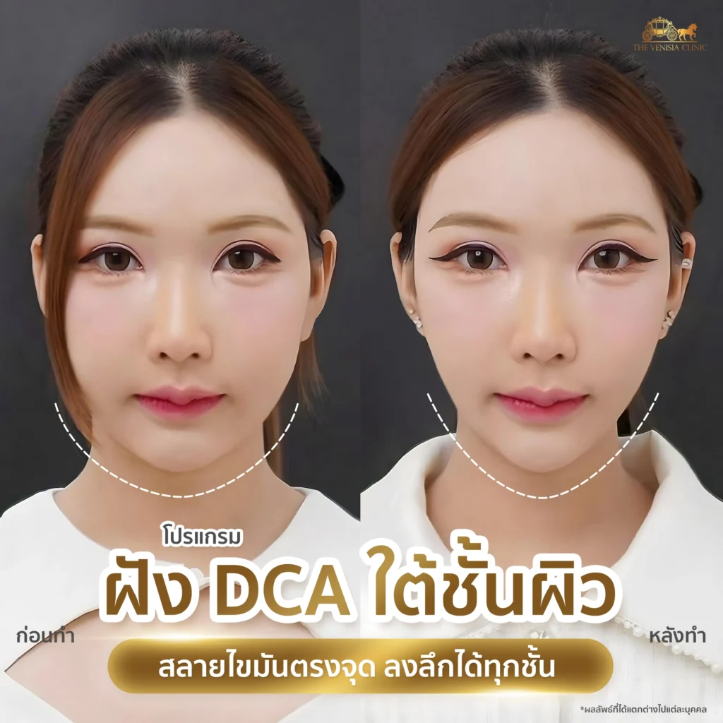 รีวิว DCA ใต้ชั้นผิว ช่วยกระชับใบหน้าให้ดูเรียวและยกกระชับขึ้น
