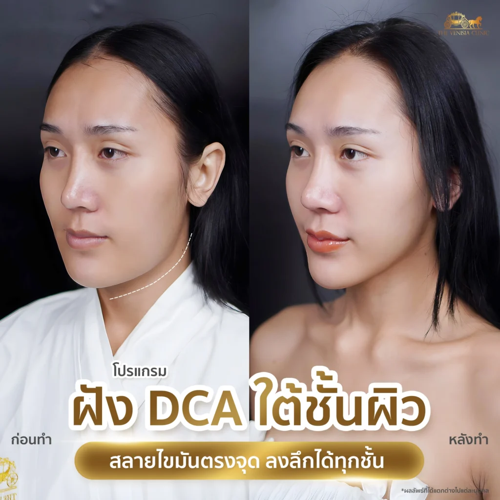 ผลลัพธ์รีวิว DCA กระชับผิวหน้าแบบธรรมชาติ หน้าไม่บวม ไม่โป๊ะ